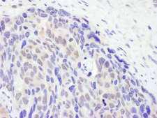 TET2 Antibody - Detection of Human TET2 by Immunohistochemistry. Sample: FFPE section of human ovarian carcinoma. Antibody: Affinity purified rabbit anti-TET2 used at a dilution of 1:5000 (0.2 Detection: DAB.