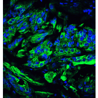 TET2 Antibody - Immunofluorescence of TET2 in human colon carcinoma tissue with TET2 antibody at 20 µg/ml.