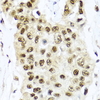 TET2 Antibody - Immunohistochemistry of paraffin-embedded human lung cancer tissue.