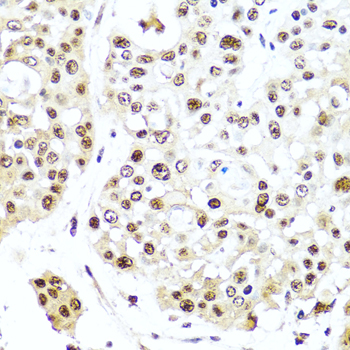 TET2 Antibody - Immunohistochemistry of paraffin-embedded human colon carcinoma tissue.