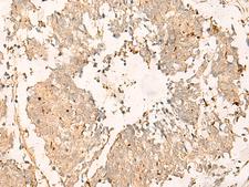 TEX11 Antibody - Immunohistochemistry of paraffin-embedded Human lung cancer tissue  using TEX11 Polyclonal Antibody at dilution of 1:30(×200)