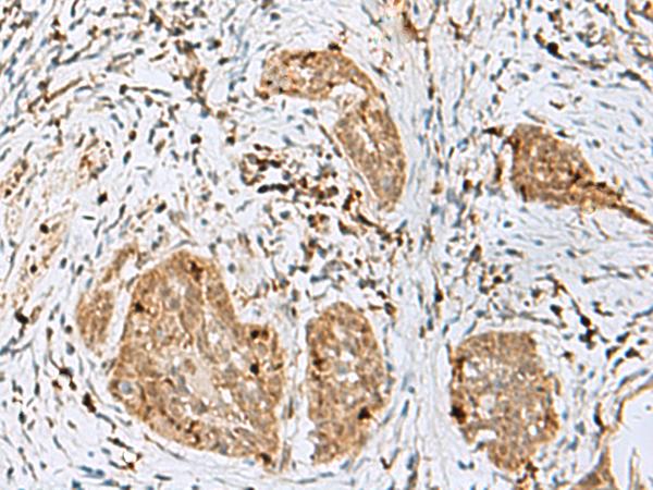 TEX11 Antibody - Immunohistochemistry of paraffin-embedded Human esophagus cancer tissue  using TEX11 Polyclonal Antibody at dilution of 1:50(×200)