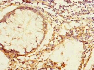 TEX43 / C5orf48 Antibody - Immunohistochemistry of paraffin-embedded human colon cancer using TEX43 Antibody at dilution of 1:100