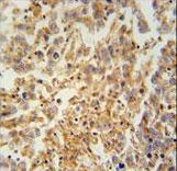 TEX9 Antibody - TEX9 antibody immunohistochemistry of formalin-fixed and paraffin-embedded human testis carcinoma followed by peroxidase-conjugated secondary antibody and DAB staining.
