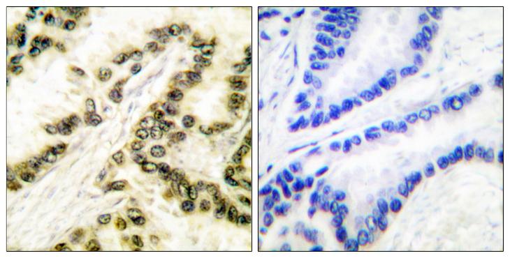 TFAP2A / AP-2 Antibody - Peptide - + Immunohistochemical analysis of paraffin-embedded human breast carcinoma tissue using AP-2 antibody.
