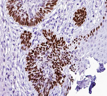 TFAP2A + TFAP2B Antibody - 1:100 staining human Skin carcinoma tissue by IHC-P. The tissue was formaldehyde fixed and a heat mediated antigen retrieval step in citrate buffer was performed. The tissue was then blocked and incubated with the antibody for 1.5 hours at 22°C. An HRP conjugated goat anti-rabbit antibody was used as the secondary.
