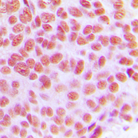 TFAP2C / AP2 Gamma Antibody - Immunohistochemical analysis of AP2 gamma staining in human breast cancer formalin fixed paraffin embedded tissue section. The section was pre-treated using heat mediated antigen retrieval with sodium citrate buffer (pH 6.0). The section was then incubated with the antibody at room temperature and detected using an HRP conjugated compact polymer system. DAB was used as the chromogen. The section was then counterstained with hematoxylin and mounted with DPX.
