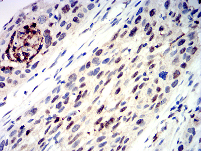 TFAP2C / AP2 Gamma Antibody - Immunohistochemical analysis of paraffin-embedded esophageal cancer tissues using TFAP2C mouse mAb with DAB staining.