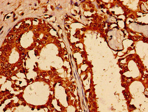 TFAP2C / AP2 Gamma Antibody - Immunohistochemistry image of paraffin-embedded human breast cancer at a dilution of 1:100