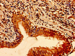 TFAP2C / AP2 Gamma Antibody - Immunohistochemistry image of paraffin-embedded human lung cancer at a dilution of 1:100