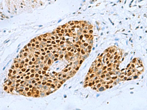 TFAP4 / AP-4 Antibody - Immunohistochemistry of paraffin-embedded Human esophagus cancer tissue  using TFAP4 Polyclonal Antibody at dilution of 1:70(×200)