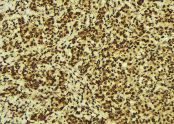 TFB1 / GTF2H1 Antibody - 1:100 staining human breast carcinoma tissue by IHC-P. The sample was formaldehyde fixed and a heat mediated antigen retrieval step in citrate buffer was performed. The sample was then blocked and incubated with the antibody for 1.5 hours at 22°C. An HRP conjugated goat anti-rabbit antibody was used as the secondary.