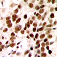 TFB1 / GTF2H1 Antibody - Immunohistochemical analysis of GTF2H1 staining in human breast cancer formalin fixed paraffin embedded tissue section. The section was pre-treated using heat mediated antigen retrieval with sodium citrate buffer (pH 6.0). The section was then incubated with the antibody at room temperature and detected with HRP and DAB as chromogen. The section was then counterstained with hematoxylin and mounted with DPX.
