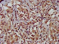 TFB1M Antibody - Immunohistochemistry image at a dilution of 1:500 and staining in paraffin-embedded human liver cancer performed on a Leica BondTM system. After dewaxing and hydration, antigen retrieval was mediated by high pressure in a citrate buffer (pH 6.0) . Section was blocked with 10% normal goat serum 30min at RT. Then primary antibody (1% BSA) was incubated at 4 °C overnight. The primary is detected by a biotinylated secondary antibody and visualized using an HRP conjugated SP system.