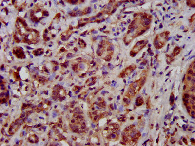 TFB1M Antibody - Immunohistochemistry image at a dilution of 1:500 and staining in paraffin-embedded human pancreatic cancer performed on a Leica BondTM system. After dewaxing and hydration, antigen retrieval was mediated by high pressure in a citrate buffer (pH 6.0) . Section was blocked with 10% normal goat serum 30min at RT. Then primary antibody (1% BSA) was incubated at 4 °C overnight. The primary is detected by a biotinylated secondary antibody and visualized using an HRP conjugated SP system.