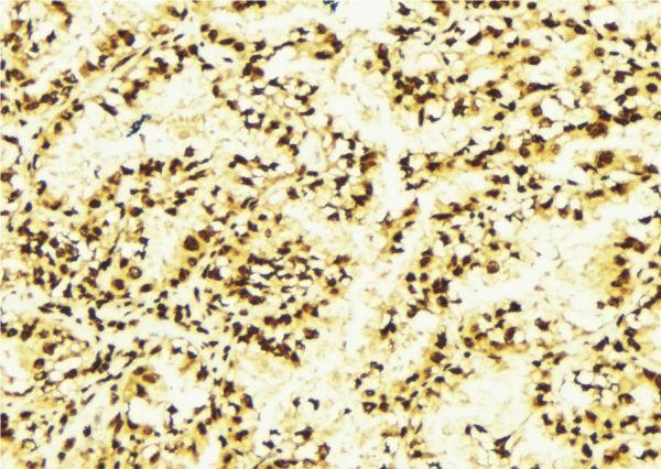 TFCP2 / CP2 Antibody - 1:100 staining human lung tissue by IHC-P. The sample was formaldehyde fixed and a heat mediated antigen retrieval step in citrate buffer was performed. The sample was then blocked and incubated with the antibody for 1.5 hours at 22°C. An HRP conjugated goat anti-rabbit antibody was used as the secondary.