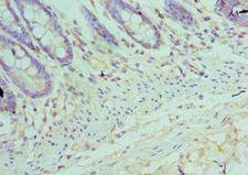 TFDP1 Antibody - Immunohistochemistry of paraffin-embedded human rectal cancer using antibody at 1:100 dilution.