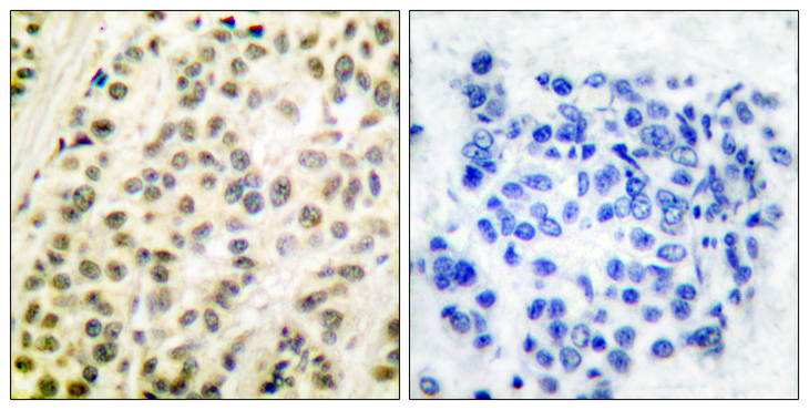 TFDP1 Antibody - Immunohistochemistry analysis of paraffin-embedded human breast carcinoma tissue, using DP-1 Antibody. The picture on the right is blocked with the synthesized peptide.