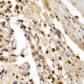 TFDP1 Antibody - Immunohistochemistry of paraffin-embedded human colon damage.