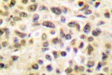 TFDP1 Antibody - IHC of DP-1/TFDP1 (V393) pAb in paraffin-embedded human breast carcinoma tissue.