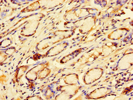 TFDP2 / DP2 Antibody - Immunohistochemistry of paraffin-embedded human gastric cancer using TFDP2 Antibody at dilution of 1:100