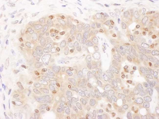 TFEB Antibody - Detection of Human TFEB by Immunohistochemistry. Sample: FFPE section of human ovarian carcinoma. Antibody: Affinity purified rabbit anti-TFEB used at a dilution of 1:1000 (1 Detection: DAB.