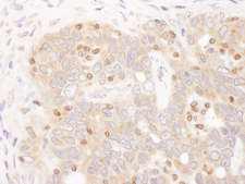 TFEB Antibody - Detection of Human TFEB by Immunohistochemistry. Sample: FFPE section of human ovarian carcinoma. Antibody: Affinity purified rabbit anti-TFEB used at a dilution of 1:1000 (1 Detection: DAB.