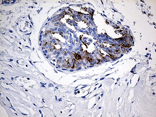 TFF1 / pS2 Antibody - Immunohistochemical staining of paraffin-embedded Human breast tissue within the normal limits using anti-TFF1 mouse monoclonal antibody. (Heat-induced epitope retrieval by 1mM EDTA in 10mM Tris buffer. (pH8.5) at 120°C for 3 min. (1:150)