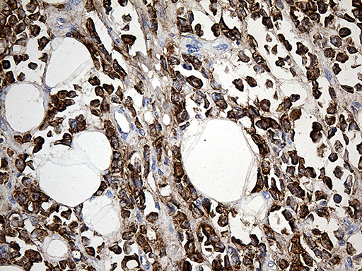 TFF1 / pS2 Antibody - Immunohistochemical staining of paraffin-embedded Adenocarcinoma of Human breast tissue tissue using anti-TFF1 mouse monoclonal antibody. (Heat-induced epitope retrieval by 1mM EDTA in 10mM Tris buffer. (pH8.5) at 120°C for 3 min. (1:150)