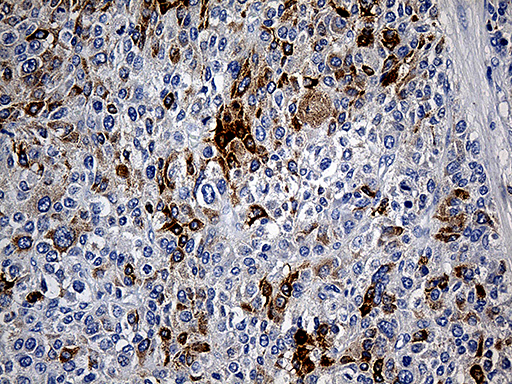 TFF1 / pS2 Antibody - Immunohistochemical staining of paraffin-embedded Carcinoma of Human liver tissue using anti-TFF1 mouse monoclonal antibody. (Heat-induced epitope retrieval by 1mM EDTA in 10mM Tris buffer. (pH8.5) at 120°C for 3 min. (1:150)