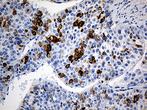 TFF1 / pS2 Antibody - Immunohistochemical staining of paraffin-embedded Carcinoma of Human liver tissue using anti-TFF1 mouse monoclonal antibody. (Heat-induced epitope retrieval by 1mM EDTA in 10mM Tris buffer. (pH8.5) at 120°C for 3 min. (1:500)