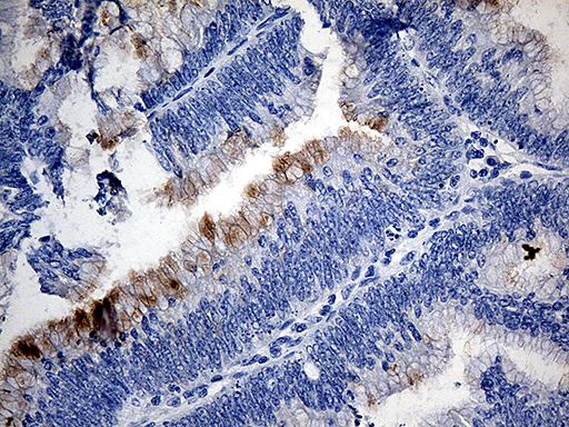 TFF1 / pS2 Antibody - Immunohistochemical staining of paraffin-embedded Adenocarcinoma of Human colon tissue using anti-TFF1 mouse monoclonal antibody. (Heat-induced epitope retrieval by 1mM EDTA in 10mM Tris buffer. (pH8.5) at 120°C for 3 min. (1:150)