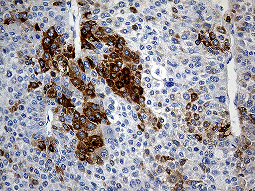 TFF1 / pS2 Antibody - Immunohistochemical staining of paraffin-embedded Carcinoma of Human liver tissue using anti-TFF1 mouse monoclonal antibody. (Heat-induced epitope retrieval by 1mM EDTA in 10mM Tris buffer. (pH8.5) at 120°C for 3 min. (1:150)