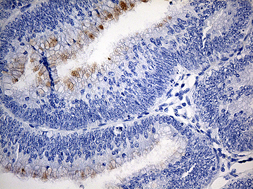 TFF1 / pS2 Antibody - Immunohistochemical staining of paraffin-embedded Adenocarcinoma of Human colon tissue using anti-TFF1 mouse monoclonal antibody. (Heat-induced epitope retrieval by 1mM EDTA in 10mM Tris buffer. (pH8.5) at 120°C for 3 min. (1:150)