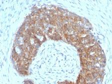 TFF1 / pS2 Antibody - Formalin-fixed, paraffin-embedded human ovarian carcinoma stained with Estrogen Inducible Protein pS2 antibody (SPM313).  This image was taken for the unmodified form of this product. Other forms have not been tested.
