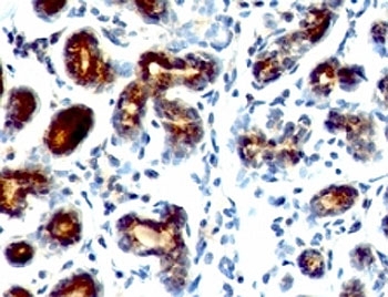 TFF1 / pS2 Antibody - Formalin-fixed, paraffin-embedded human breast carcinoma stained with pS2 antibody (SPM573).  This image was taken for the unmodified form of this product. Other forms have not been tested.