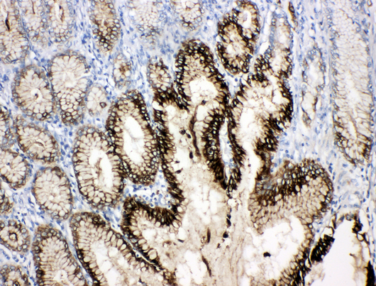 TFF1 / pS2 Antibody - TFF1 / PS2 antibody. IHC(P): Human Gastric Cancer Tissue.