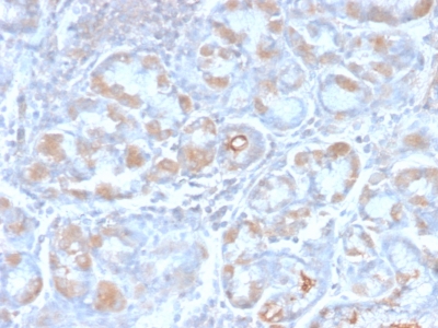 TFF1 / pS2 Antibody - Formalin-fixed, paraffin-embedded human Stomach Carcinoma stained with pS2 Rabbit Recombinant Monoclonal Antibody (TFF1/2969R).