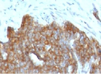 TFF1 / pS2 Antibody - IHC testing of FFPE ovarian carcinoma with TFF1 antibody (clone BCEIP1).  This image was taken for the unmodified form of this product. Other forms have not been tested.