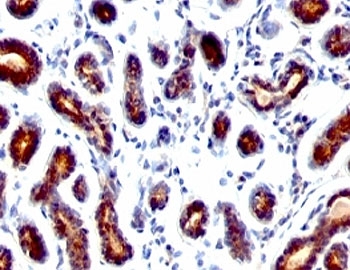 TFF1 / pS2 Antibody - Formalin-fixed, paraffin-embedded human breast carcinoma stained with TFF1 antibody.  This image was taken for the unmodified form of this product. Other forms have not been tested.