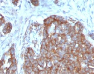 TFF1 / pS2 Antibody - Formalin-fixed, paraffin-embedded human ovarian carcinoma stained with TFF1 antibody.  This image was taken for the unmodified form of this product. Other forms have not been tested.