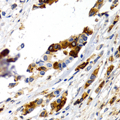 TFF1 / pS2 Antibody - Immunohistochemistry of paraffin-embedded human mammary cancer using TFF1 antibodyat dilution of 1:200 (40x lens).