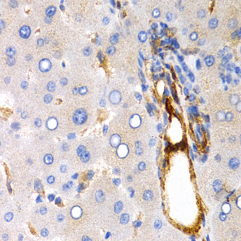 TFF1 / pS2 Antibody - Immunohistochemistry of paraffin-embedded human liver cancer using TFF1 antibodyat dilution of 1:200 (40x lens).