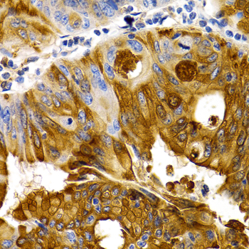 TFF1 / pS2 Antibody - Immunohistochemistry of paraffin-embedded human colon carcinoma using TFF1 antibodyat dilution of 1:200 (40x lens).