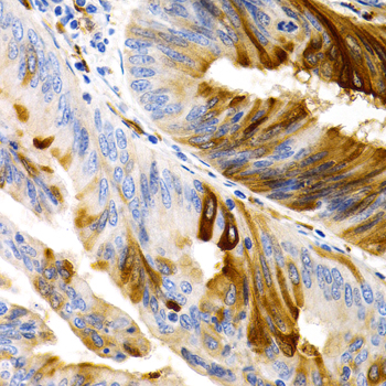 TFF1 / pS2 Antibody - Immunohistochemistry of paraffin-embedded human colon carcinoma using TFF1 antibodyat dilution of 1:200 (40x lens).