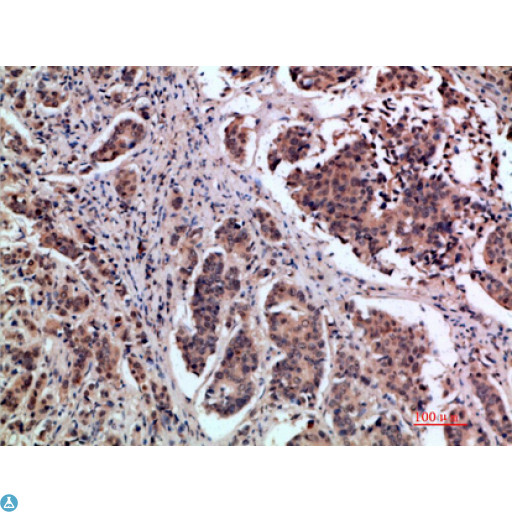 TFF1 / pS2 Antibody - Immunohistochemical analysis of paraffin-embedded human-breast-cancer, antibody was diluted at 1:200.