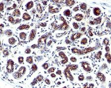 TFF1 / pS2 Antibody - Estrogen inducible protein pS2 antibody GE2 immunohistochemistry breast cancer.  This image was taken for the unmodified form of this product. Other forms have not been tested.