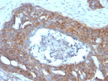 TFF1 / pS2 Antibody - IHC testing of FFPE human ovarian carcinoma with Estrogen Inducible Protein pS2 antibody