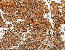 TFF2 / SP Antibody - Immunohistochemistry of paraffin-embedded Human ovarian cancer using TFF2 Polyclonal Antibody at dilution of 1:40.
