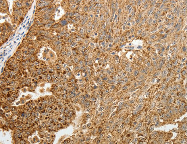 TFF2 / SP Antibody - Immunohistochemistry of paraffin-embedded Human ovarian cancer using TFF2 Polyclonal Antibody at dilution of 1:40.